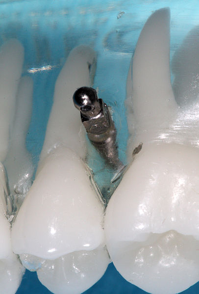 Model mikroimplantu służącego do zakotwiczenia aparatu ortodontycznego