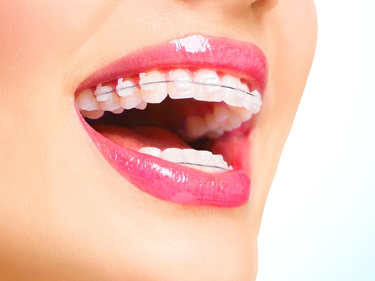 Uśmiech - zęby z aparatem ortodontycznym